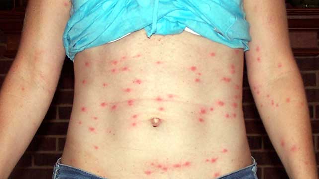 Chiggers – Invisible but Unforgettable! | N.C. Cooperative Extension